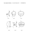 Mitral Valve Coaptation Plate For Mitral Valve Regurgitation diagram and image