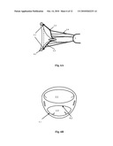 Mitral Valve Coaptation Plate For Mitral Valve Regurgitation diagram and image