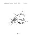 Mitral Valve Coaptation Plate For Mitral Valve Regurgitation diagram and image