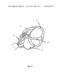 Mitral Valve Coaptation Plate For Mitral Valve Regurgitation diagram and image