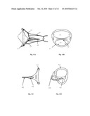 Mitral Valve Coaptation Plate For Mitral Valve Regurgitation diagram and image