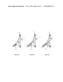 Mitral Valve Coaptation Plate For Mitral Valve Regurgitation diagram and image