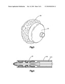 POROUS CONTAINMENT DEVICE AND ASSOCIATED METHOD FOR STABILIZATION OF VERTEBRAL COMPRESSION FRACTURES diagram and image