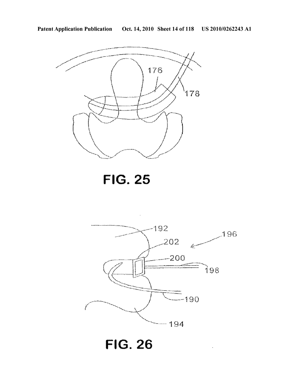 SPINE DISTRACTION IMPLANT - diagram, schematic, and image 16