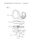 Modular Knee Prosthesis diagram and image