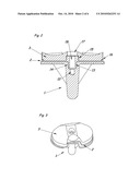 Modular Knee Prosthesis diagram and image