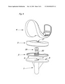 Modular Knee Prosthesis diagram and image