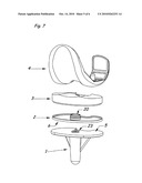 Modular Knee Prosthesis diagram and image