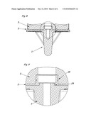 Modular Knee Prosthesis diagram and image