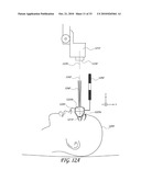 GONIOSCOPE FOR IMPROVED VIEWING diagram and image