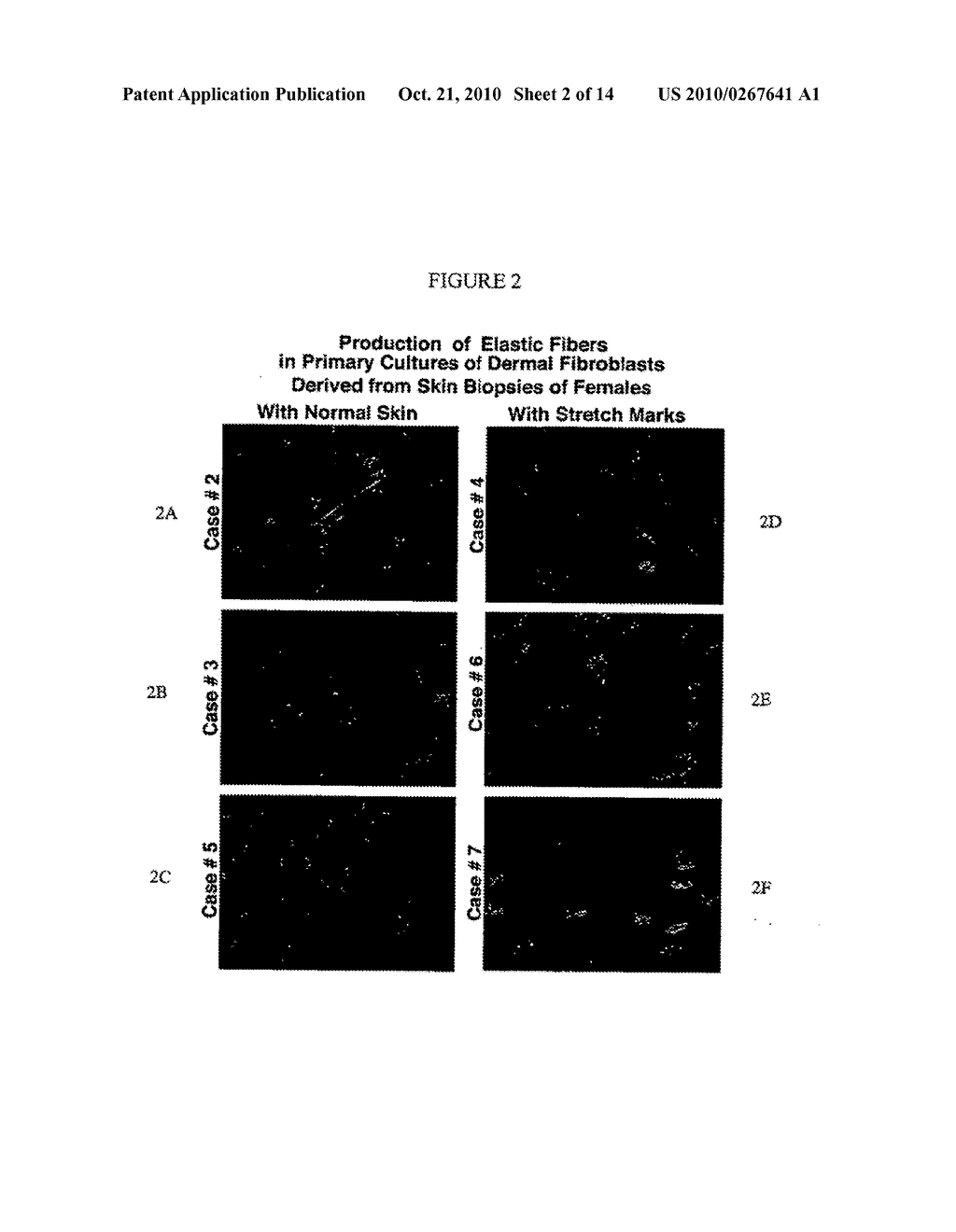 PROGNOSTIC TESTS FOR DEVELOPMENT OF DERMAL STRETCH MARKS AND IMPLICATIONS FOR THE PREVENTATIVE TREATMENT THEREOF - diagram, schematic, and image 03