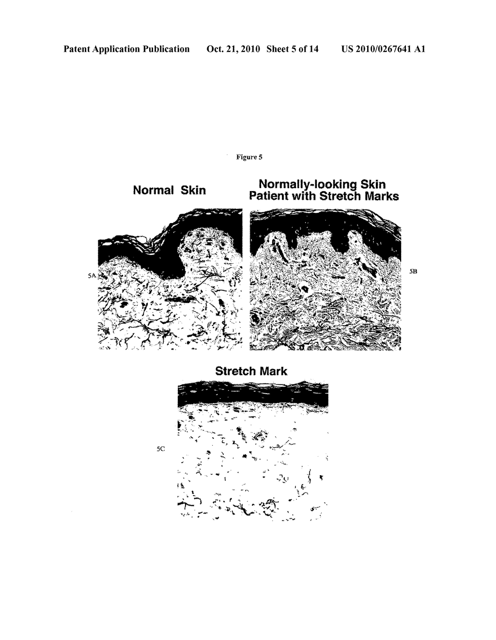 PROGNOSTIC TESTS FOR DEVELOPMENT OF DERMAL STRETCH MARKS AND IMPLICATIONS FOR THE PREVENTATIVE TREATMENT THEREOF - diagram, schematic, and image 06