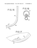 METHODS AND APPARATUS FOR INTRAOCULAR BRACHYTHERAPY diagram and image