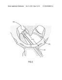 DELIVERY SLEEVE FOR PELVIC FLOOR IMPLANTS diagram and image