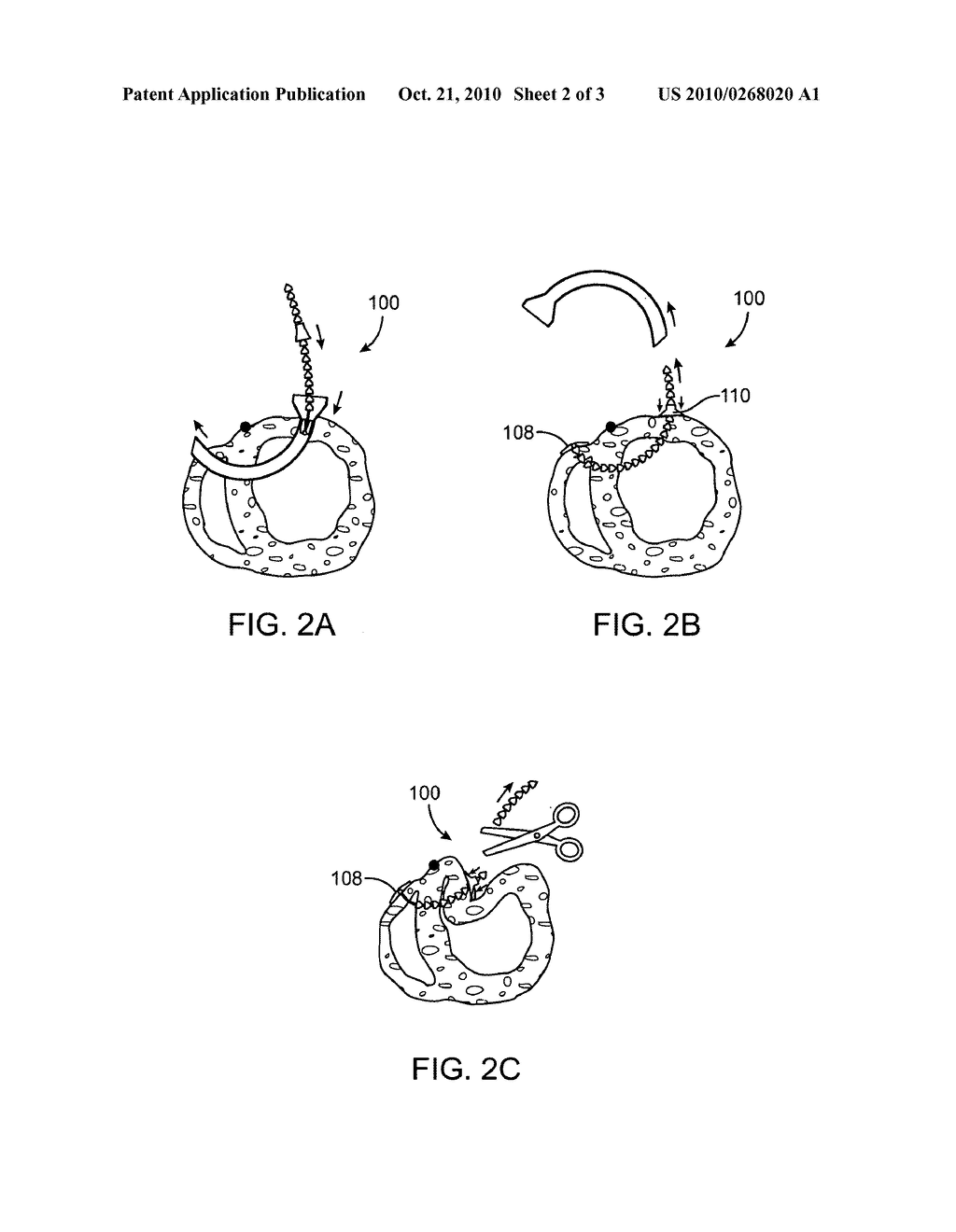 Method and Apparatus For Closing Off a Portion of a Heart Ventricle - diagram, schematic, and image 03