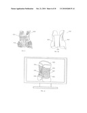 MODULAR CUSTOM BRACES, CASTS AND DEVICES AND METHODS FOR DESIGNING AND FABRICATING diagram and image