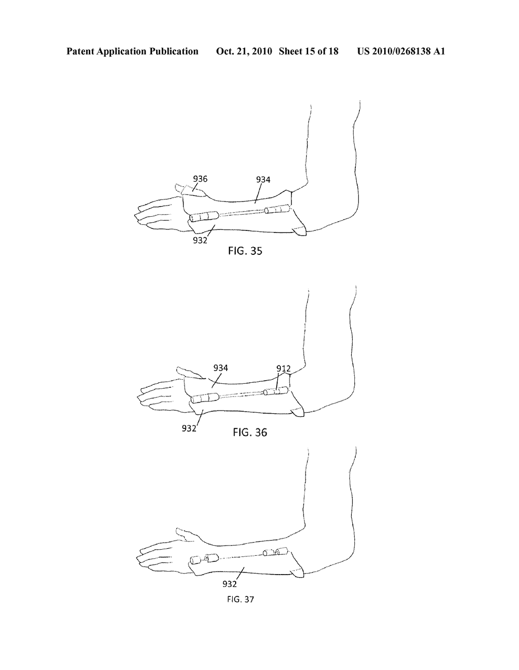 CUSTOM BRACES, CASTS AND DEVICES HAVING LIMITED FLEXIBILITY AND METHODS FOR DESIGNING AND FABRICATING - diagram, schematic, and image 16