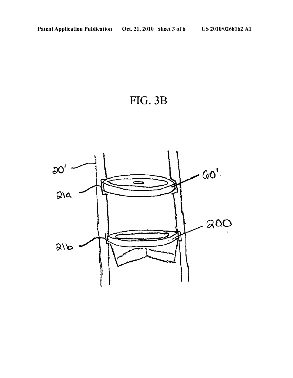 CANNULA WITH SEALING ELEMENTS - diagram, schematic, and image 04