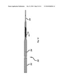 Implant Delivery System diagram and image