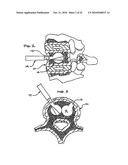 EXPANDABLE POROUS MESH BAG DEVICE AND METHODS OF USE FOR REDUCTION, FILLING, FIXATION AND SUPPORTING OF BONE diagram and image