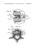 EXPANDABLE POROUS MESH BAG DEVICE AND METHODS OF USE FOR REDUCTION, FILLING, FIXATION AND SUPPORTING OF BONE diagram and image