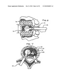 EXPANDABLE POROUS MESH BAG DEVICE AND METHODS OF USE FOR REDUCTION, FILLING, FIXATION AND SUPPORTING OF BONE diagram and image