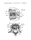 EXPANDABLE POROUS MESH BAG DEVICE AND METHODS OF USE FOR REDUCTION, FILLING, FIXATION AND SUPPORTING OF BONE diagram and image