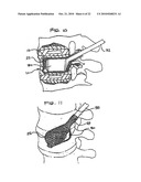 EXPANDABLE POROUS MESH BAG DEVICE AND METHODS OF USE FOR REDUCTION, FILLING, FIXATION AND SUPPORTING OF BONE diagram and image