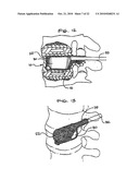 EXPANDABLE POROUS MESH BAG DEVICE AND METHODS OF USE FOR REDUCTION, FILLING, FIXATION AND SUPPORTING OF BONE diagram and image