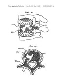 EXPANDABLE POROUS MESH BAG DEVICE AND METHODS OF USE FOR REDUCTION, FILLING, FIXATION AND SUPPORTING OF BONE diagram and image