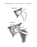 EXPANDABLE POROUS MESH BAG DEVICE AND METHODS OF USE FOR REDUCTION, FILLING, FIXATION AND SUPPORTING OF BONE diagram and image