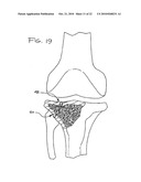 EXPANDABLE POROUS MESH BAG DEVICE AND METHODS OF USE FOR REDUCTION, FILLING, FIXATION AND SUPPORTING OF BONE diagram and image