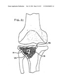 EXPANDABLE POROUS MESH BAG DEVICE AND METHODS OF USE FOR REDUCTION, FILLING, FIXATION AND SUPPORTING OF BONE diagram and image