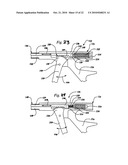 EXPANDABLE POROUS MESH BAG DEVICE AND METHODS OF USE FOR REDUCTION, FILLING, FIXATION AND SUPPORTING OF BONE diagram and image