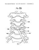 EXPANDABLE POROUS MESH BAG DEVICE AND METHODS OF USE FOR REDUCTION, FILLING, FIXATION AND SUPPORTING OF BONE diagram and image