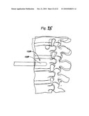 EXPANDABLE POROUS MESH BAG DEVICE AND METHODS OF USE FOR REDUCTION, FILLING, FIXATION AND SUPPORTING OF BONE diagram and image