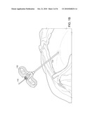 Devices and Methods for Vertebrostenting diagram and image