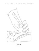 Devices and Methods for Vertebrostenting diagram and image