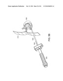 Devices and Methods for Vertebrostenting diagram and image