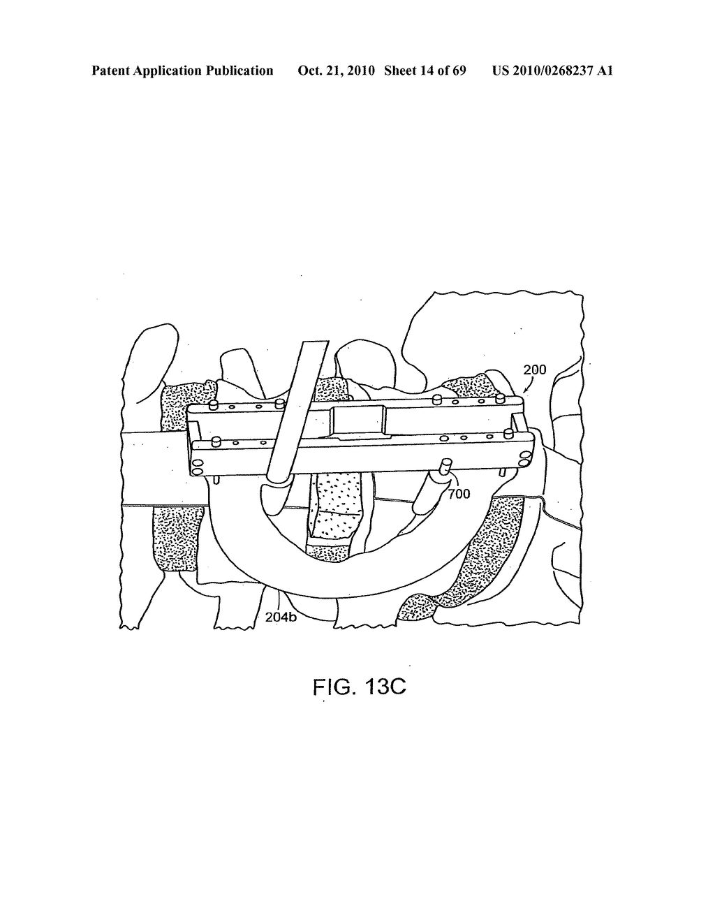 Systems, Devices and Apparatuses For Bony Fixation and Disk Repair and Replacement Methods Related Thereto - diagram, schematic, and image 15