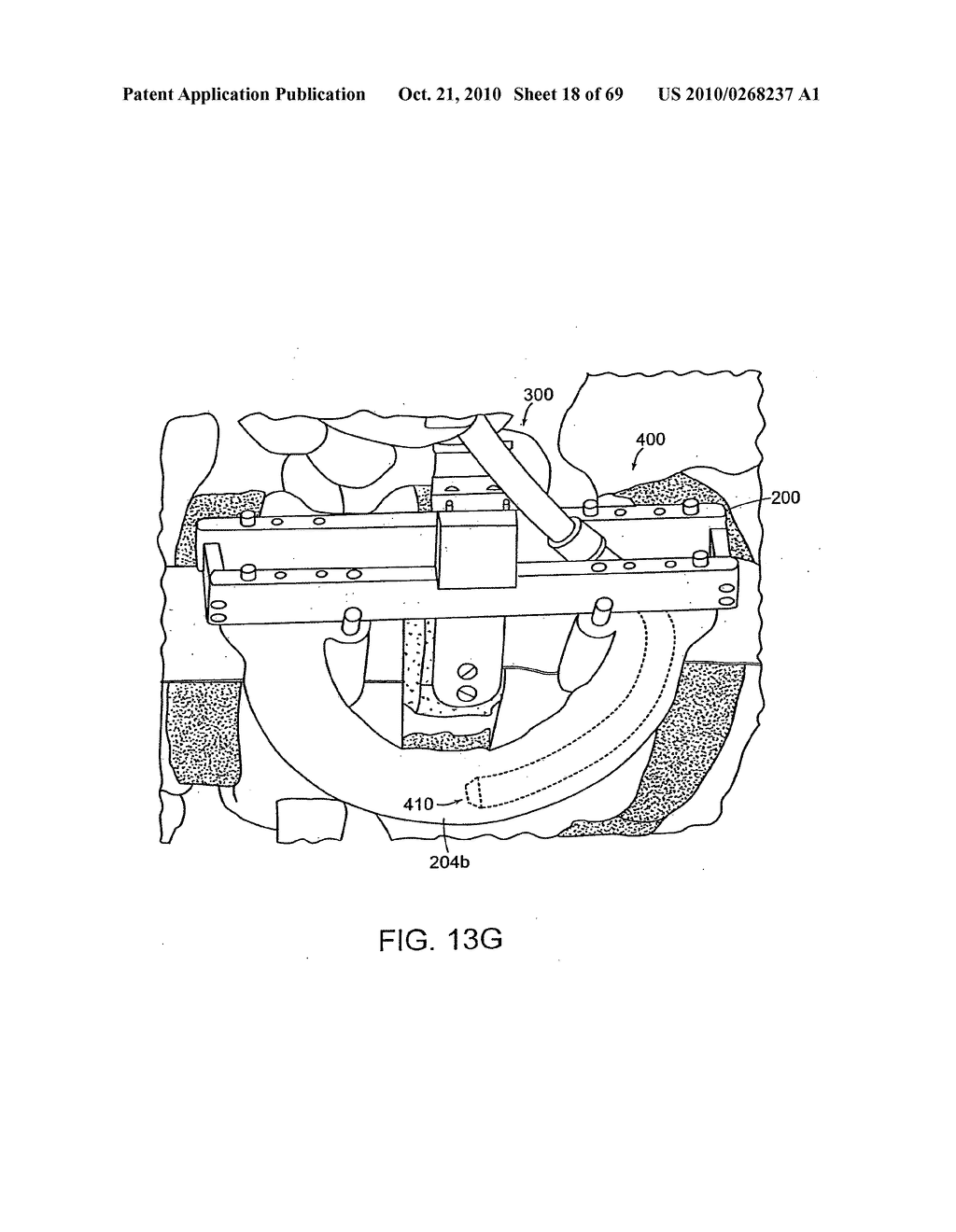 Systems, Devices and Apparatuses For Bony Fixation and Disk Repair and Replacement Methods Related Thereto - diagram, schematic, and image 19