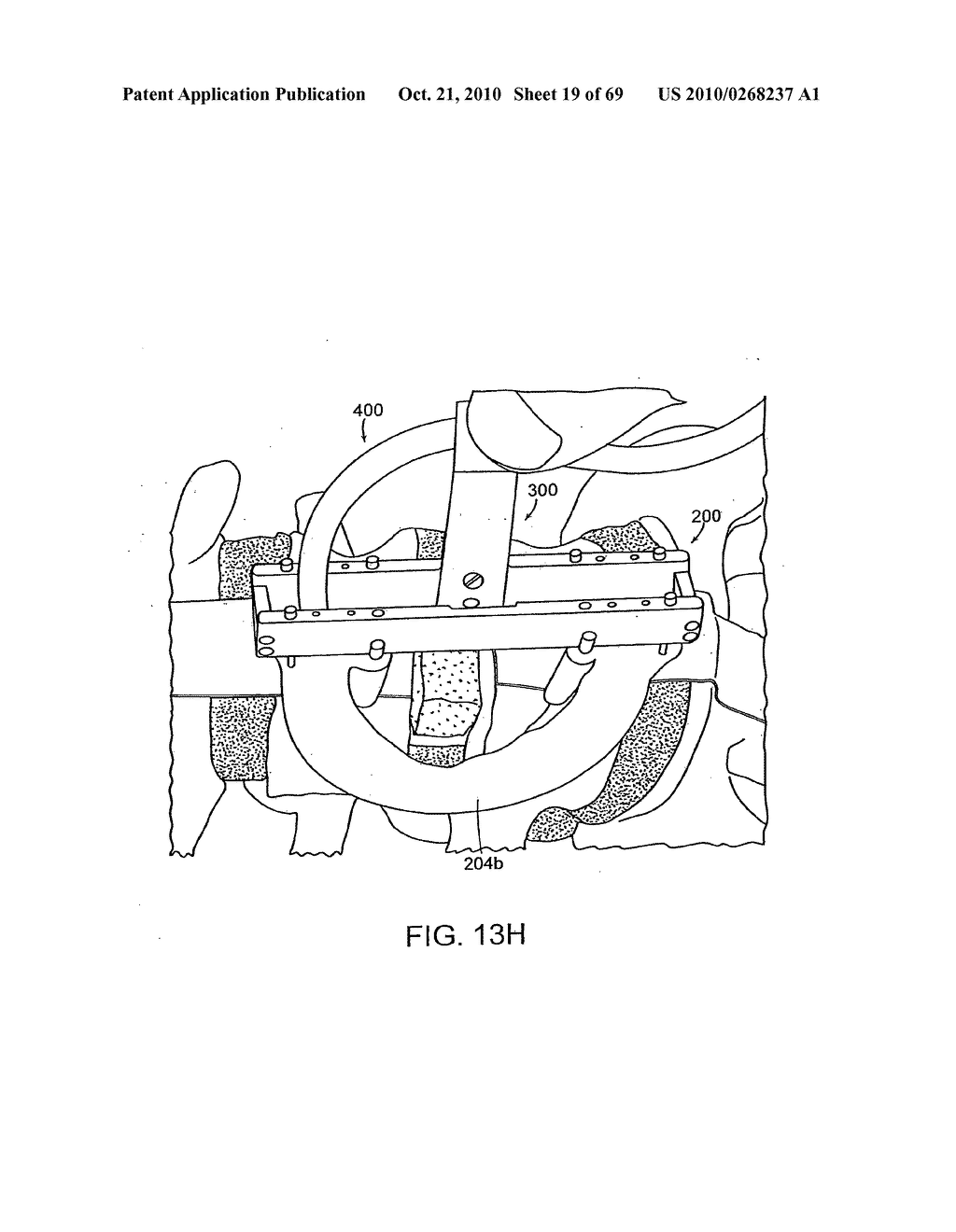 Systems, Devices and Apparatuses For Bony Fixation and Disk Repair and Replacement Methods Related Thereto - diagram, schematic, and image 20