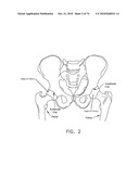 METHOD AND APPARATUS FOR ACCESSING THE INTERIOR OF A HIP JOINT, INCLUDING THE PROVISION AND USE OF A NOVEL TELESCOPING ACCESS CANNULA AND A NOVEL TELESCOPING OBTURATOR diagram and image