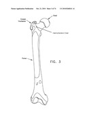 METHOD AND APPARATUS FOR ACCESSING THE INTERIOR OF A HIP JOINT, INCLUDING THE PROVISION AND USE OF A NOVEL TELESCOPING ACCESS CANNULA AND A NOVEL TELESCOPING OBTURATOR diagram and image