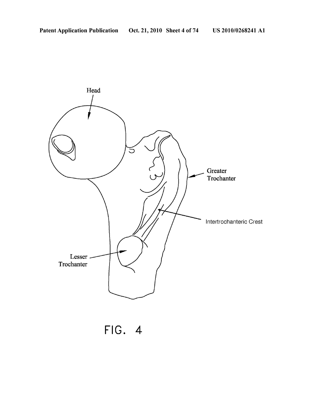 METHOD AND APPARATUS FOR ACCESSING THE INTERIOR OF A HIP JOINT, INCLUDING THE PROVISION AND USE OF A NOVEL TELESCOPING ACCESS CANNULA AND A NOVEL TELESCOPING OBTURATOR - diagram, schematic, and image 05