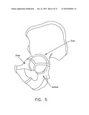 METHOD AND APPARATUS FOR ACCESSING THE INTERIOR OF A HIP JOINT, INCLUDING THE PROVISION AND USE OF A NOVEL TELESCOPING ACCESS CANNULA AND A NOVEL TELESCOPING OBTURATOR diagram and image