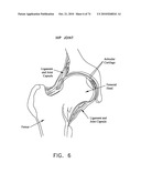 METHOD AND APPARATUS FOR ACCESSING THE INTERIOR OF A HIP JOINT, INCLUDING THE PROVISION AND USE OF A NOVEL TELESCOPING ACCESS CANNULA AND A NOVEL TELESCOPING OBTURATOR diagram and image