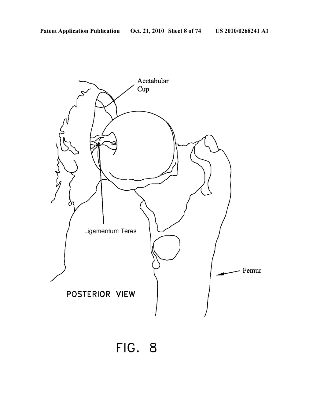 METHOD AND APPARATUS FOR ACCESSING THE INTERIOR OF A HIP JOINT, INCLUDING THE PROVISION AND USE OF A NOVEL TELESCOPING ACCESS CANNULA AND A NOVEL TELESCOPING OBTURATOR - diagram, schematic, and image 09