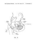 METHOD AND APPARATUS FOR ACCESSING THE INTERIOR OF A HIP JOINT, INCLUDING THE PROVISION AND USE OF A NOVEL TELESCOPING ACCESS CANNULA AND A NOVEL TELESCOPING OBTURATOR diagram and image