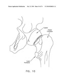 METHOD AND APPARATUS FOR ACCESSING THE INTERIOR OF A HIP JOINT, INCLUDING THE PROVISION AND USE OF A NOVEL TELESCOPING ACCESS CANNULA AND A NOVEL TELESCOPING OBTURATOR diagram and image